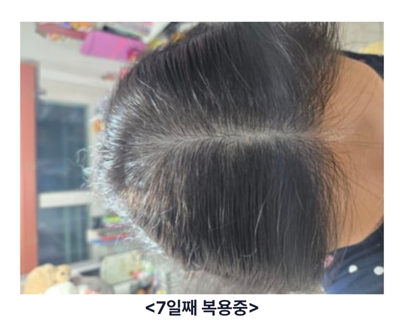 1주 두피