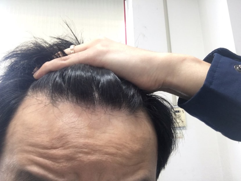 M자 탈모 현재