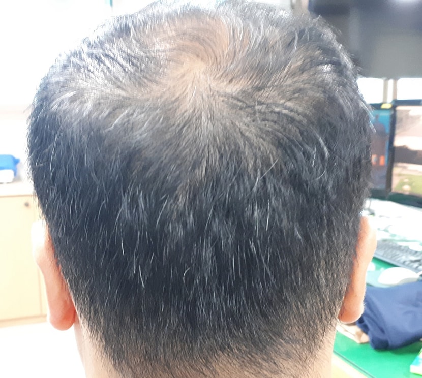 2020년 후두부 사진
