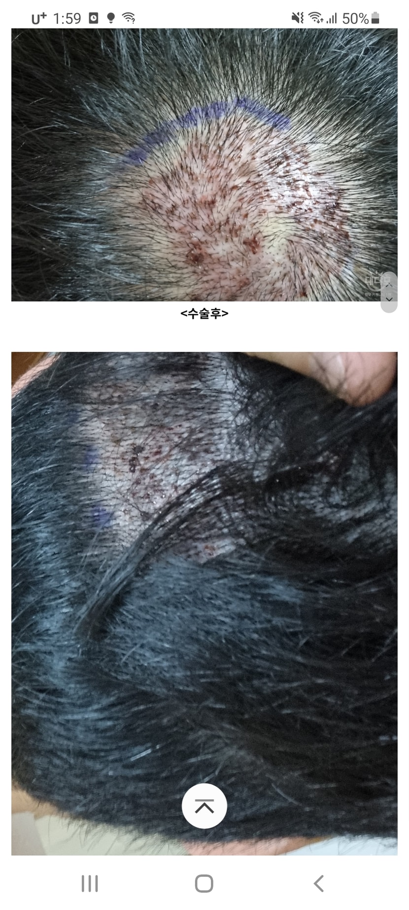 수술후 바로찍은사진