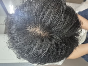 복용 3개월차