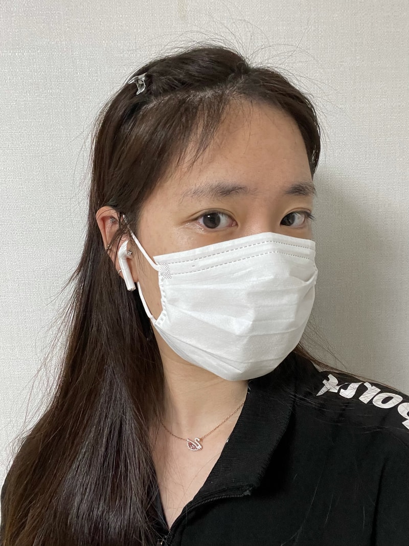 모디헤어플란트 모발이식 6개월 경과