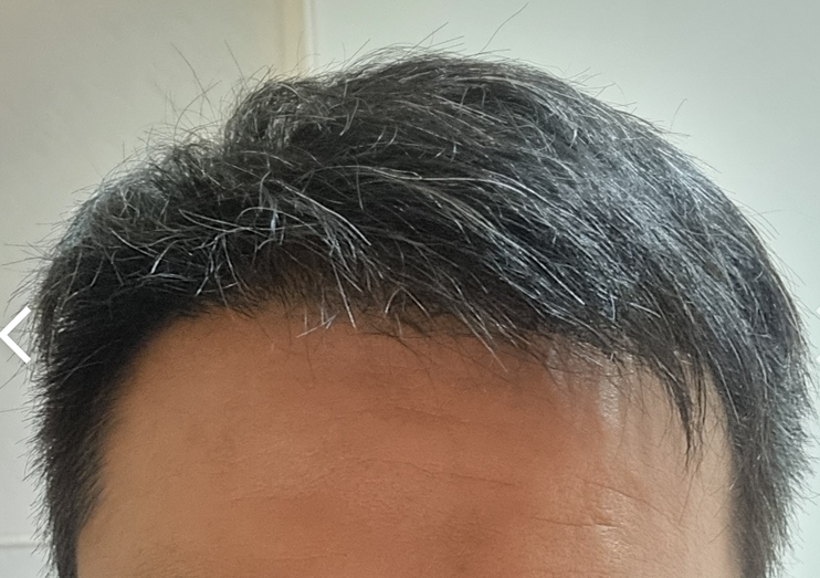 비절개 2350모낭 148일후기