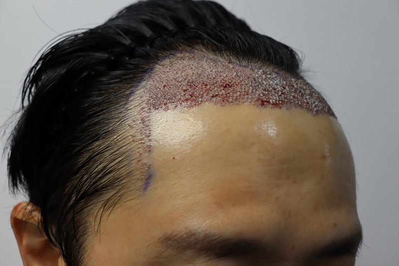 수술후.JPG