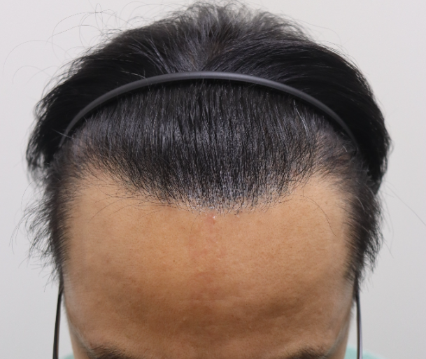 박성현수술후2.png