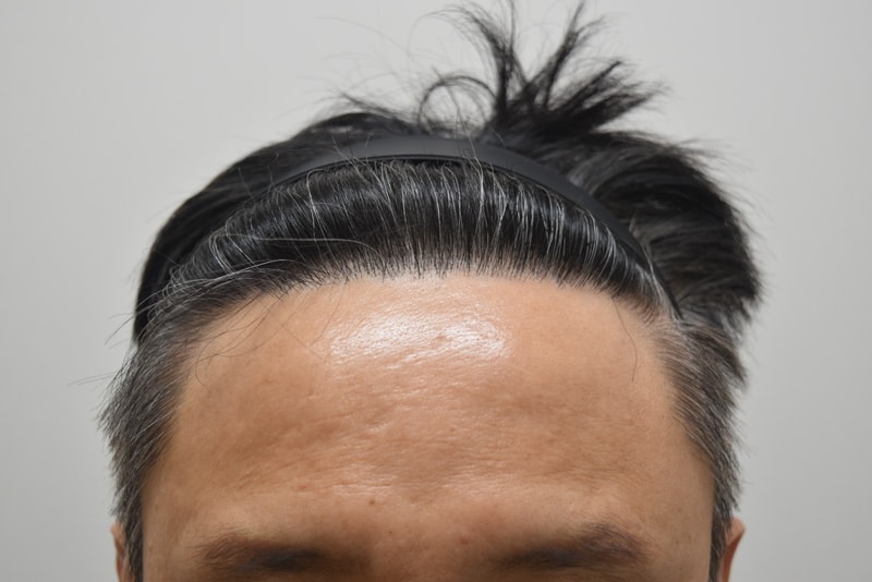 이석용수술후.jpg