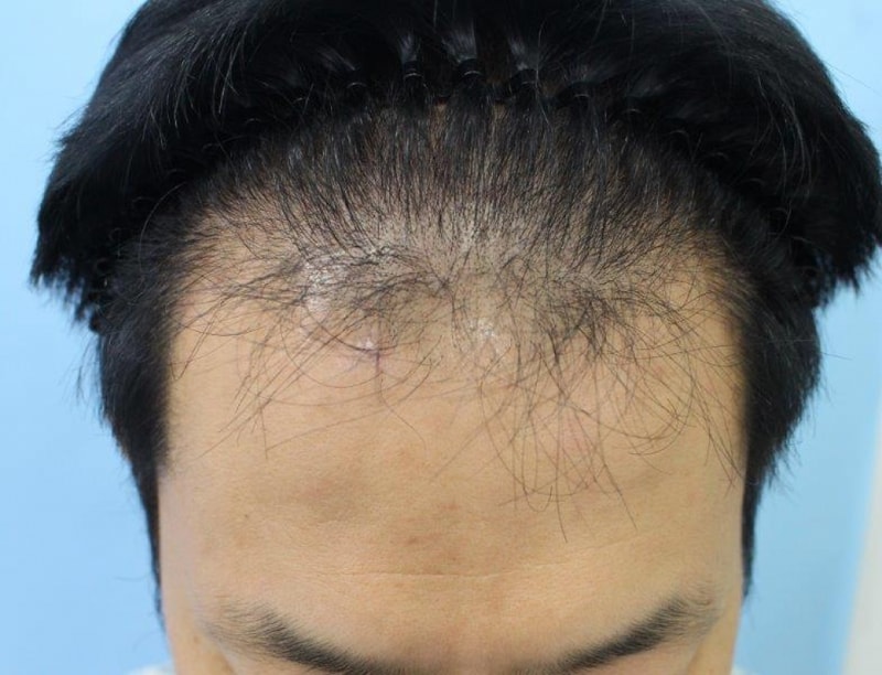 수술전 정면.jpg