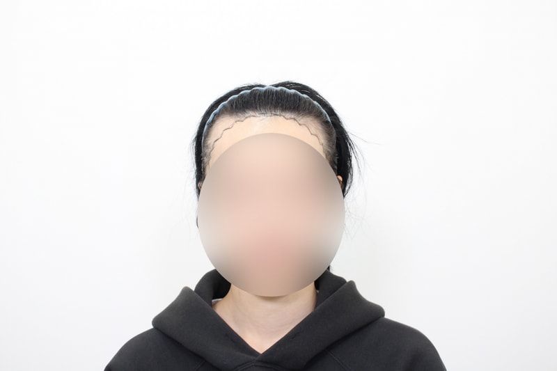 신사역 모프로의원 헤어라인 교정 2주 차 후기
