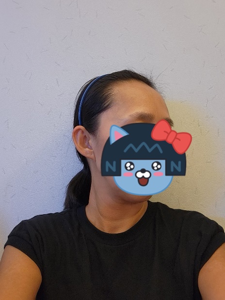 모원성형외과 헤어라인 모발이식 10일차 !! 두번째 후기올려요^^ (박종옥원장님)
