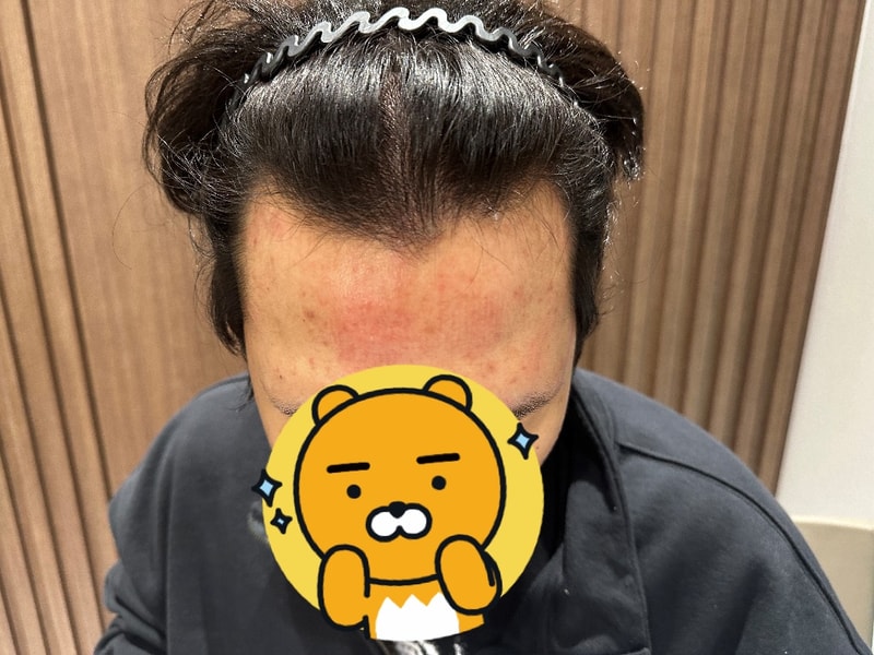 모원성형외과 무삭발비절개 10일차 후기도 올려봐요^^