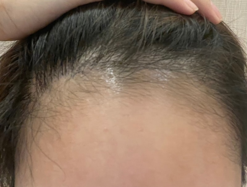 [모디헤어플란트]헤어라인모발이식6개월차후기