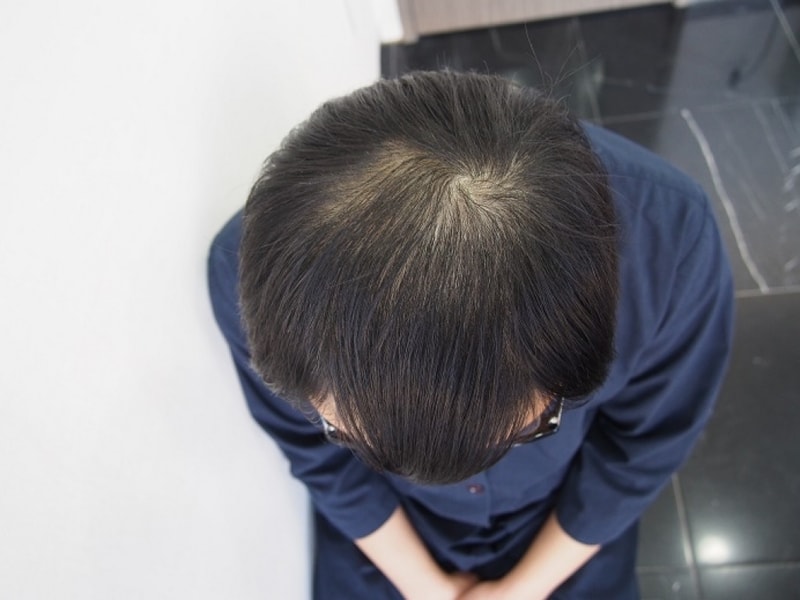 수술전 정수리.JPG