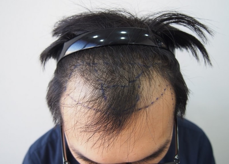 수술전 M자.JPG