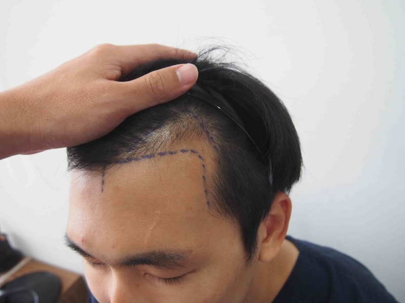 비절개 1377모낭 헤어라인 이식 8개월 경과.