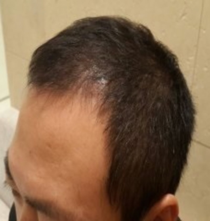 2000모낭 심은지 120일 지난 포헤어 후기~