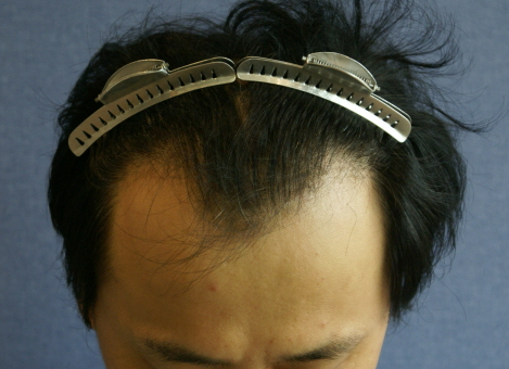 수술전 정면위.bmp