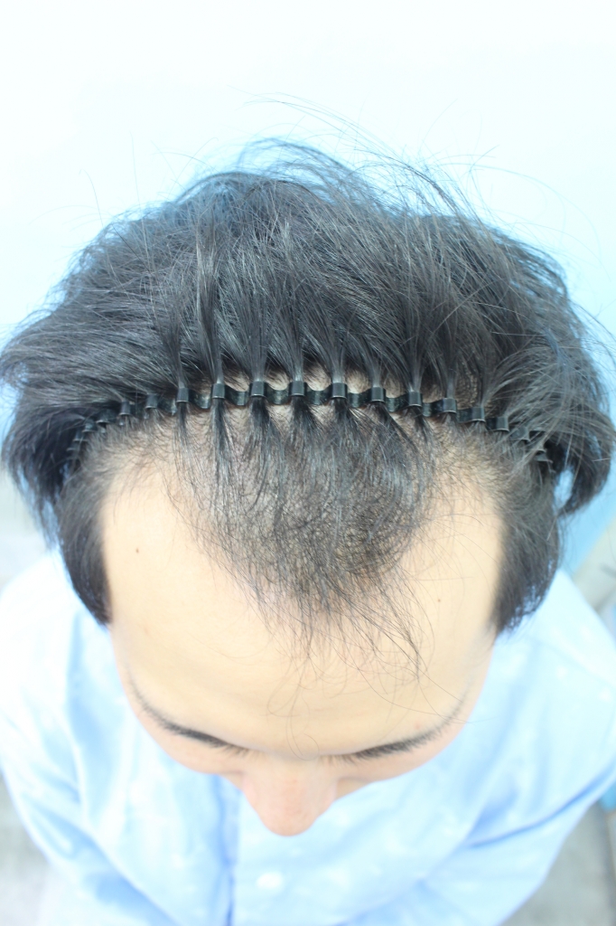 手術7ヶ月の後期です