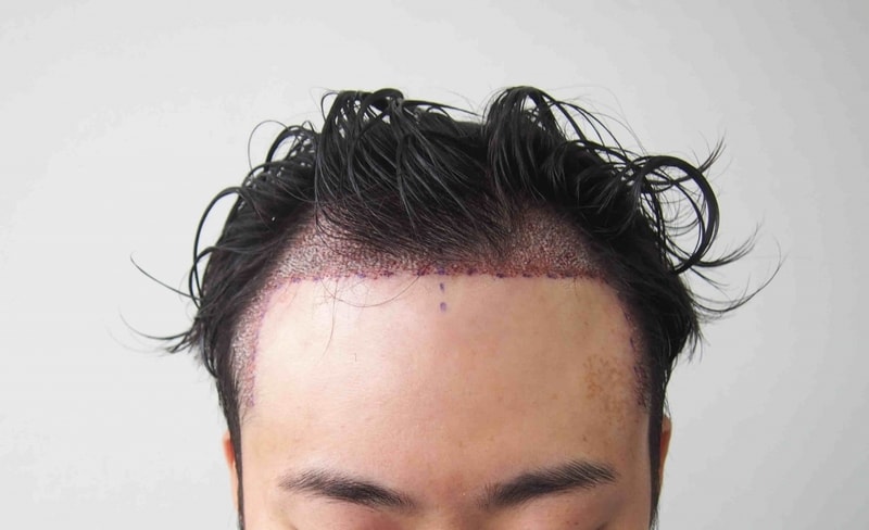 수술후 1.JPG