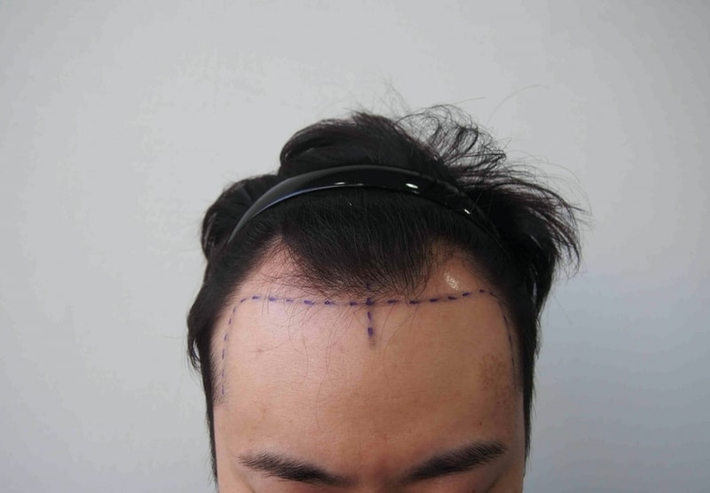 [모재성]이식 후기 입니다.