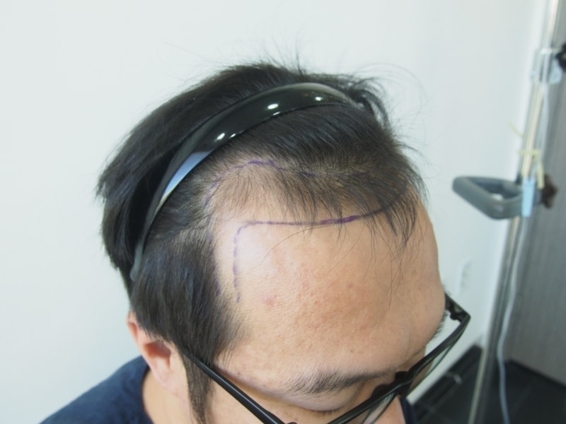 수술당일 사진