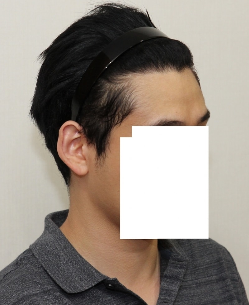 수술후오른쪽.jpg