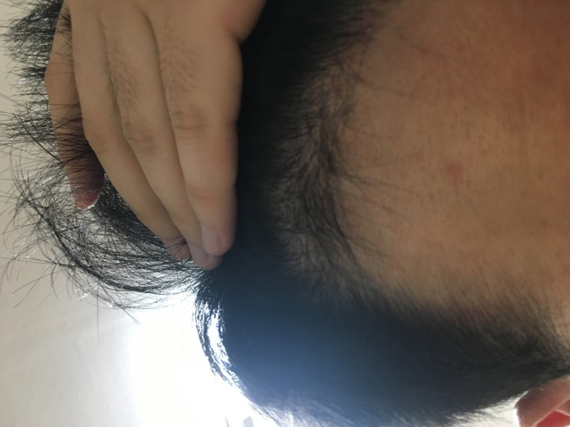 모재성 비절개 4개월차 수술후기입니다.