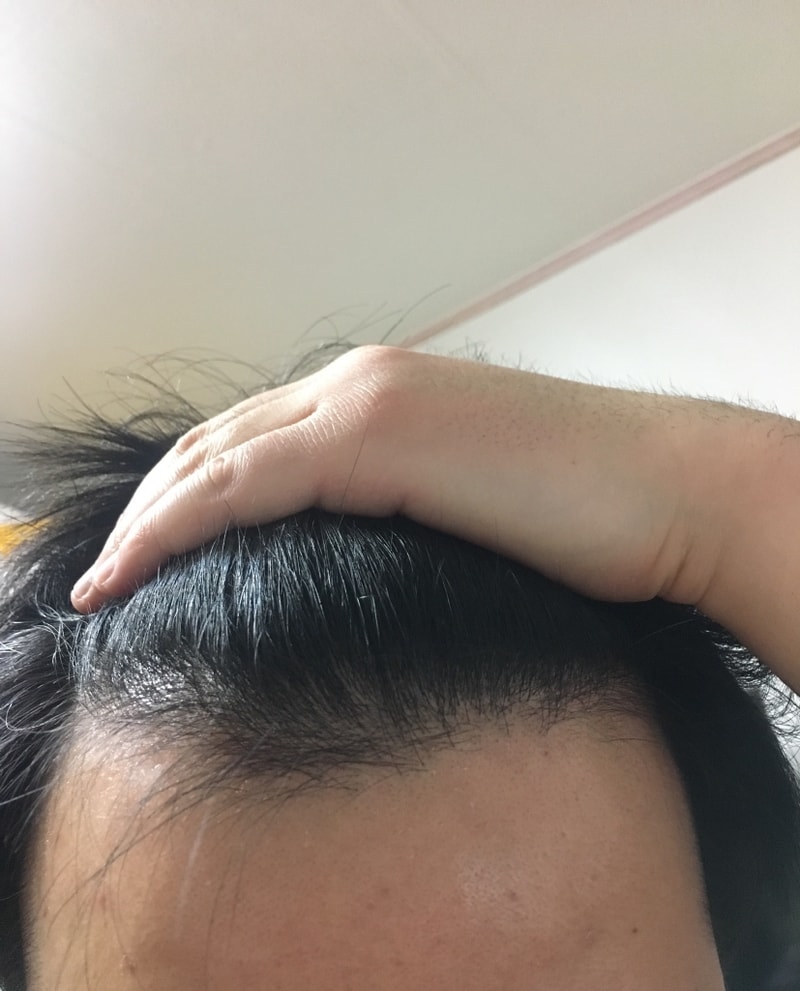 모재성 2000모 비절개 1년차 수술후기입니다.
