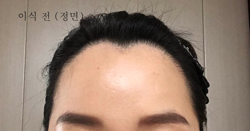 이식 전 정면.jpg