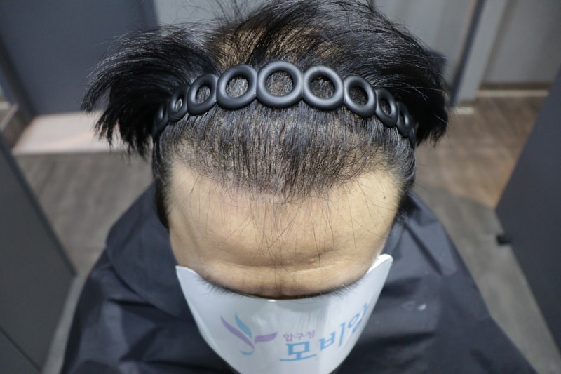 모발이식 후 10일 경과