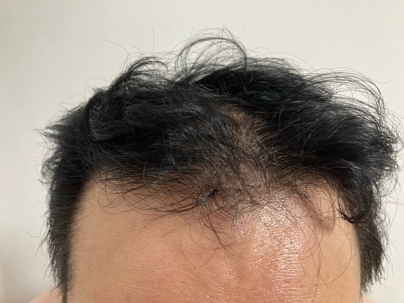 M자 비절개 무삭발 2주차 후기