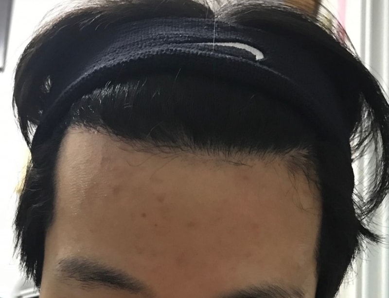 이식후 정면 올림머리(집).jpg