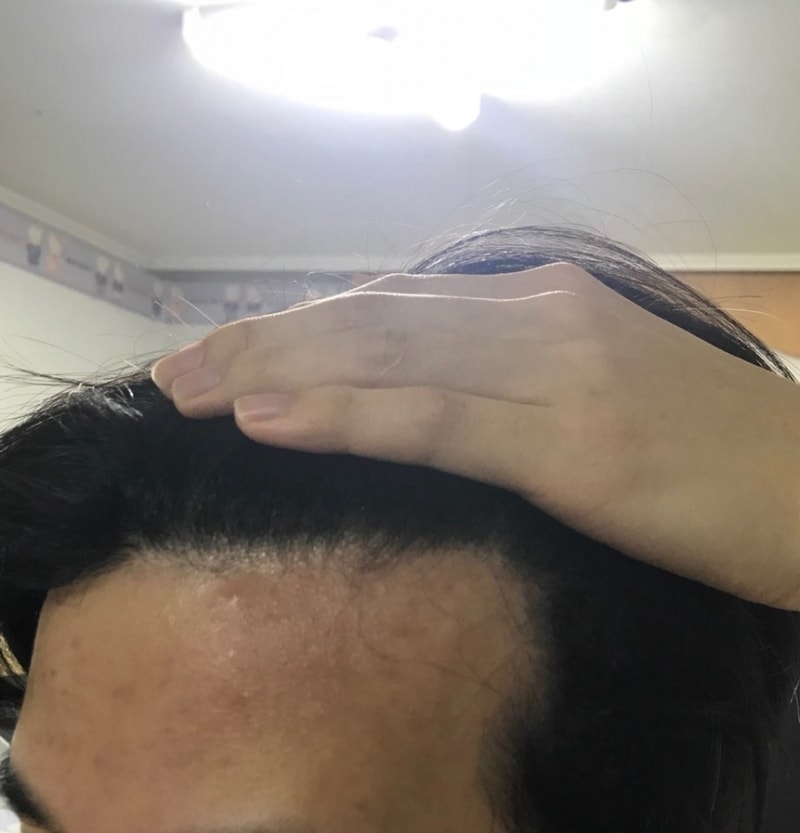 이식후 6개월 왼쪽(셀카).jpg