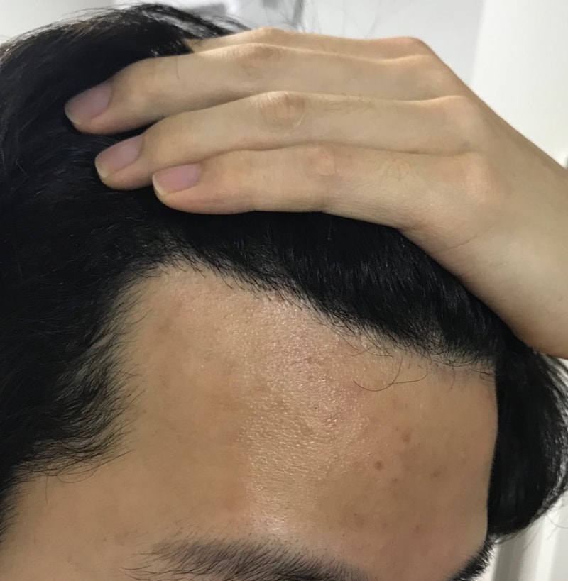 이식후 6개월 오른쪽(셀카).jpg