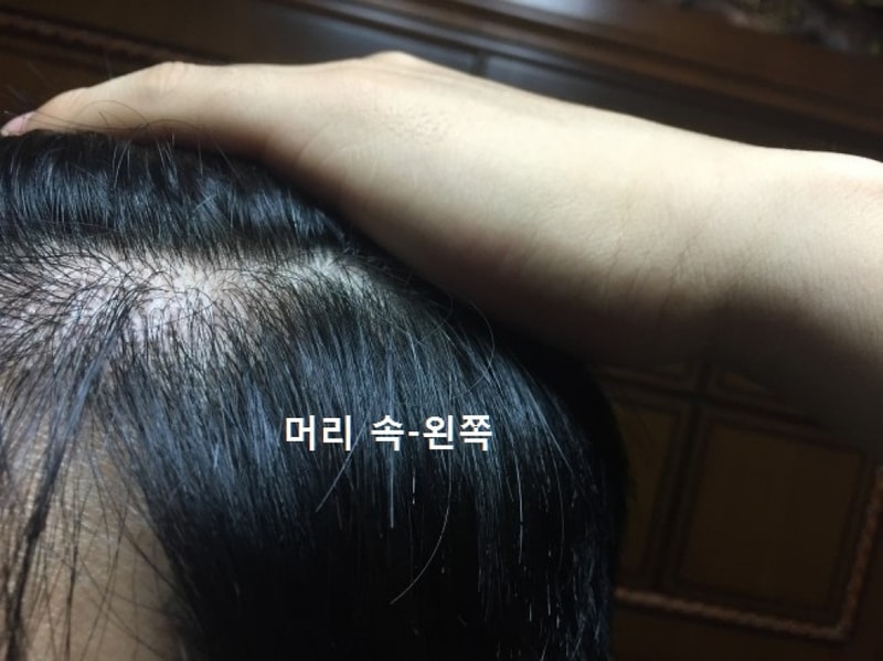 발게 왼쪽.jpg