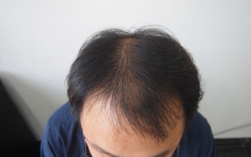 모재성 비절개 2788모낭(6411모) 이식 후기 입니다.