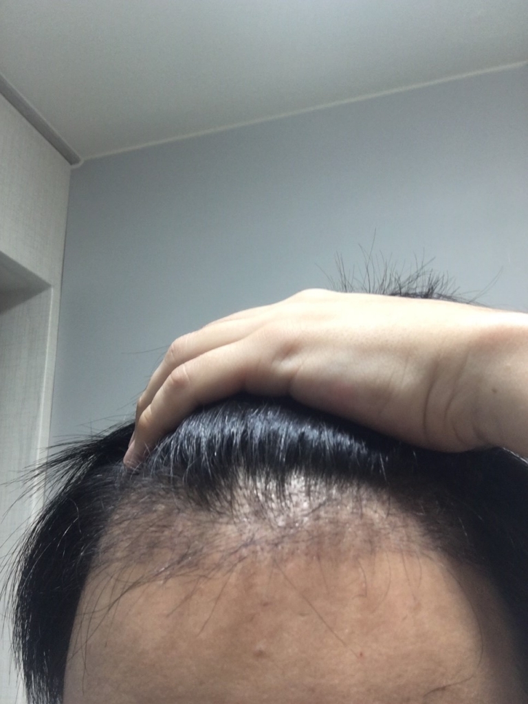 수술3개월차1.JPG