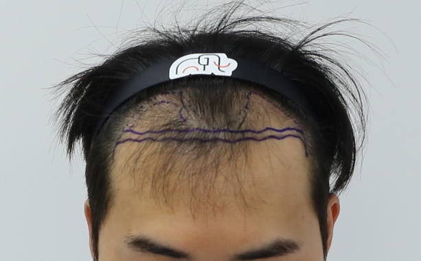 수술전 앞모습.jpg