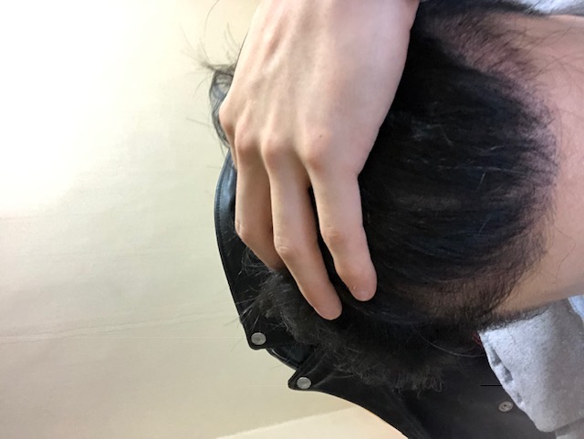 비절개 3180모 4개월차