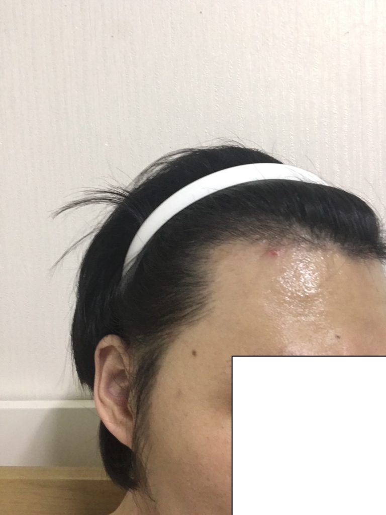 4개월차 1600모낭(견적) 비절개 엠자 및 구렛나루