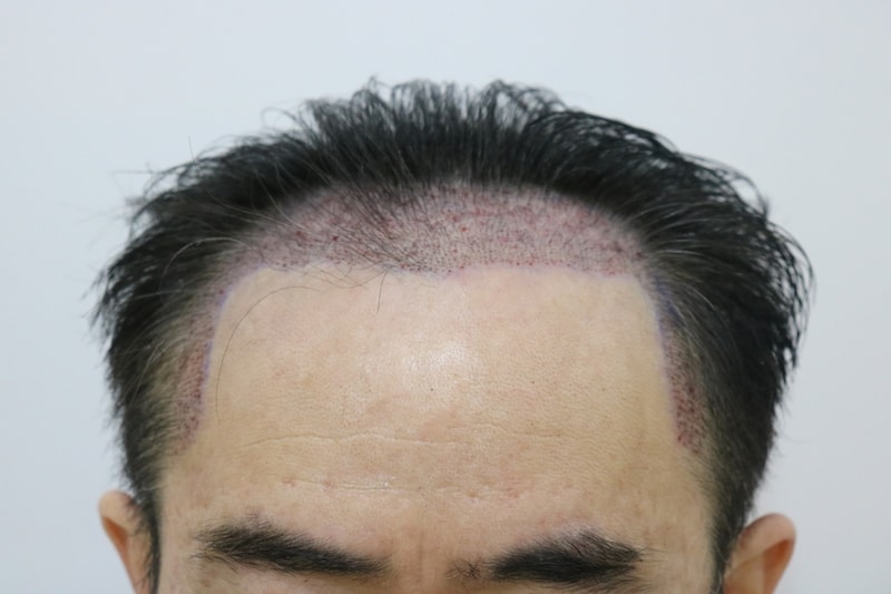 비절개라인컷으로 수술받았습니다.