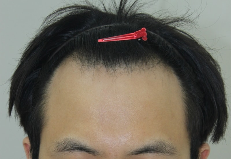 깊은 엠자 비절개 슬릿 수술