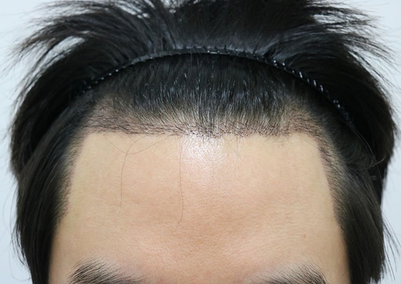 미니모발이식 한 두번째 후기입니다