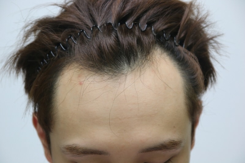 수술받았습니다.
