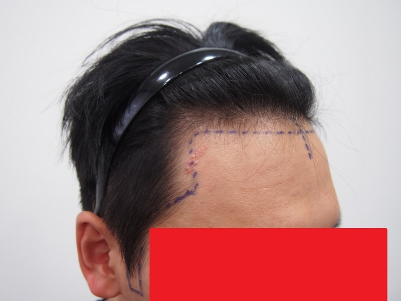 모재성 헤어라인 구렛나루  비절개 1414모낭 13일차