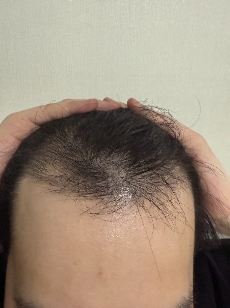뉴헤어 비절개 모발이식 2500모낭 3개월 후기입니다 (헤어라인, 정수리)