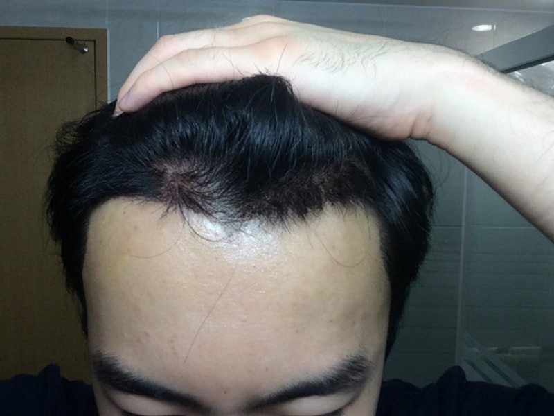 수술 후 3일.JPG