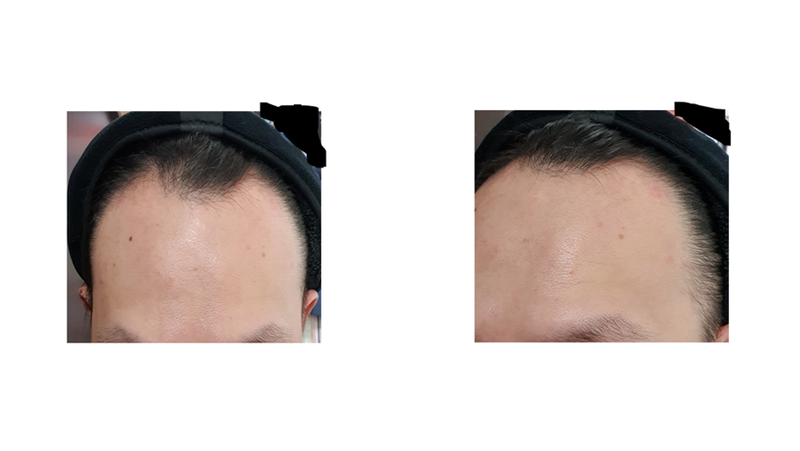 이식전.png