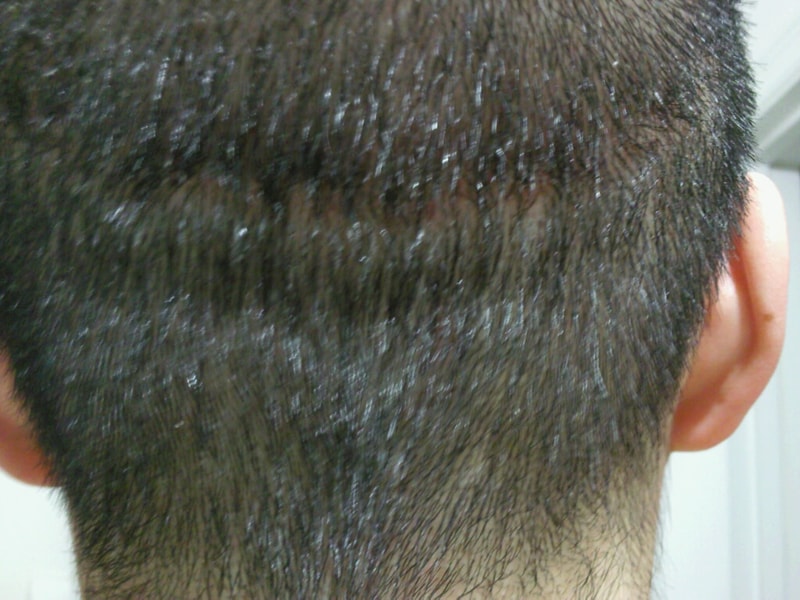 Photo0265 후두부 실밥제거후.jpeg