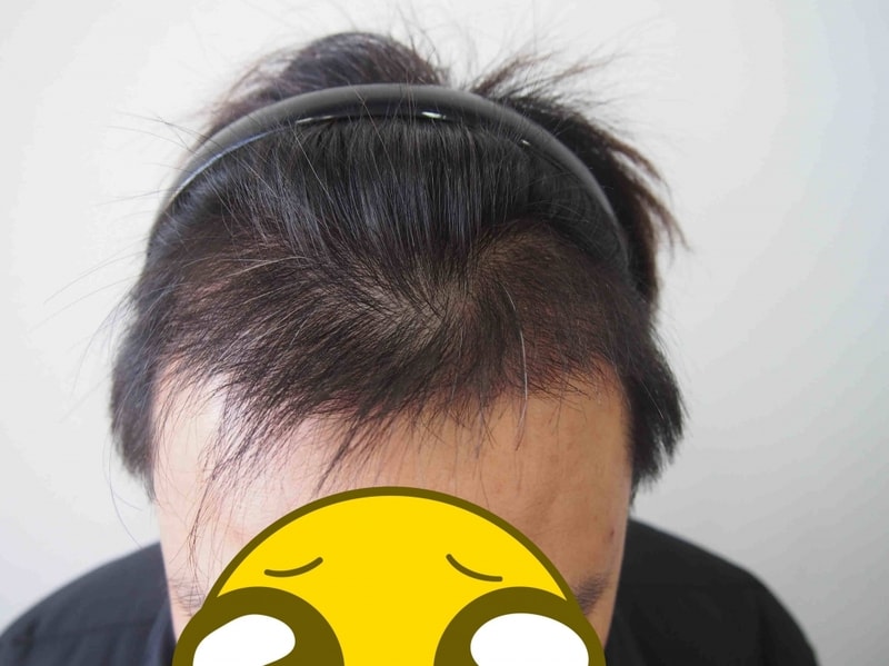 M자 2614모낭 비절개 4개월 후기입니다.