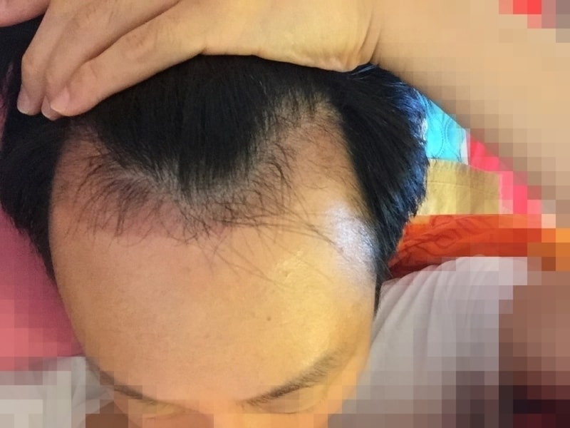 4899모 M자 수술 7개월 후기